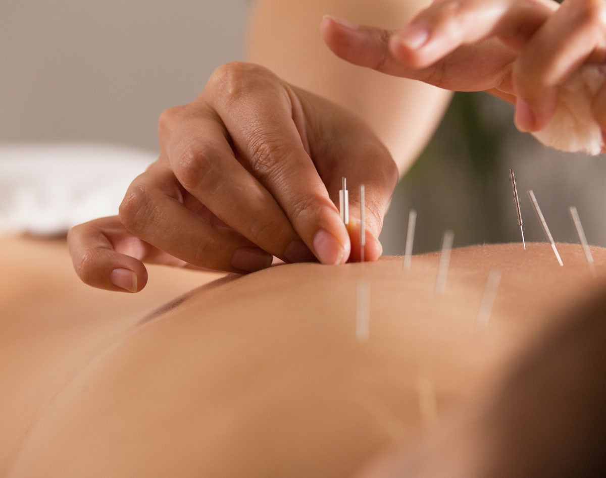 SanBao acupunctuur